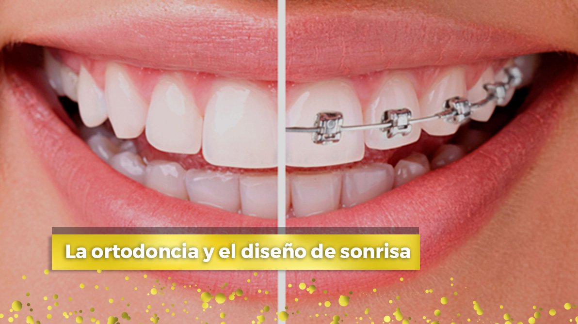 La ortodoncia y el diseño de sonrisa