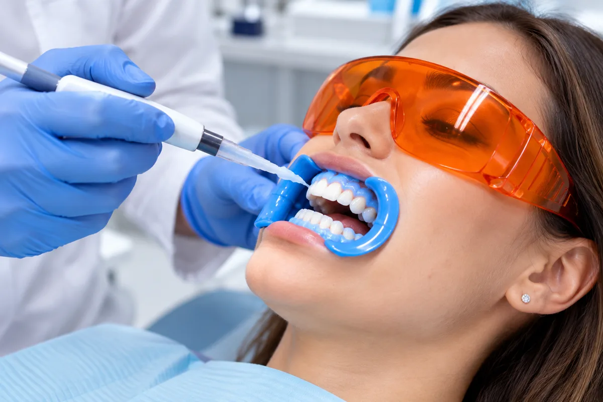 Blanqueamiento dental en consultorio: aplicación de gel blanqueador con protección de encías y gafas